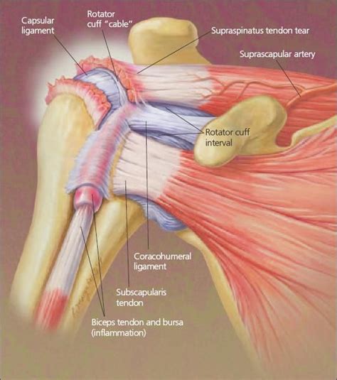 Rotator Cuff Tendonitis