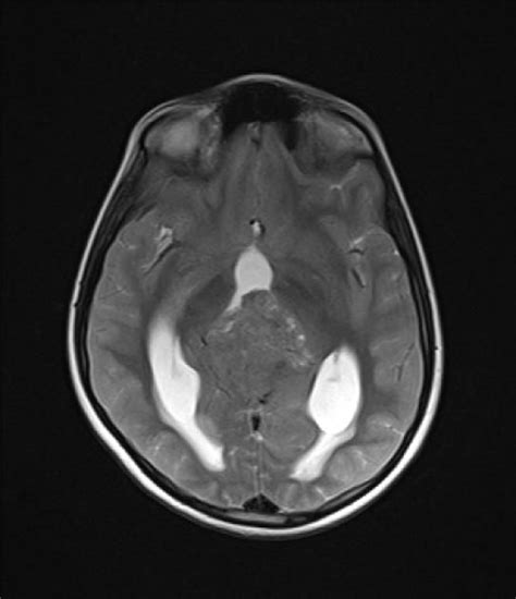 Pineoblastoma | Radiology Case | Radiopaedia.org Pet Ct, Pineal Gland ...