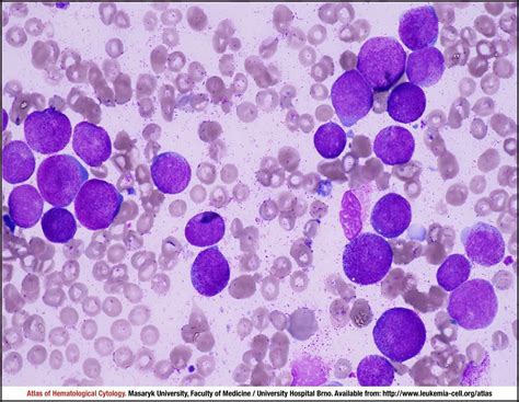 Acute Promyelocytic Leukaemia With Npm1 Rara Cell Atlas Of Haematological Cytology