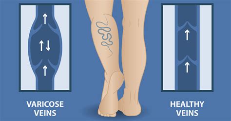 Varicose Veins All You Need To Know Care24