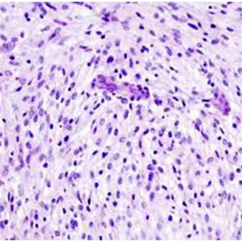 Leiomyosarcoma - Symptoms, Types, Causes & Diagnosis