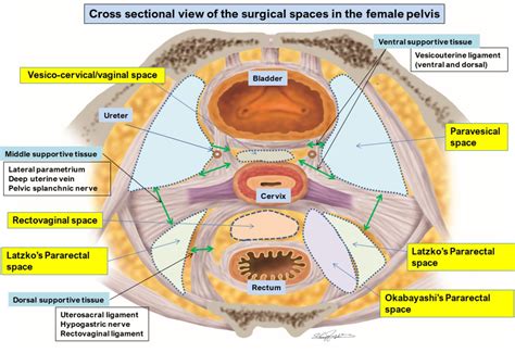 Avascular Spaces In Radical Hysterectomy International Journal Of