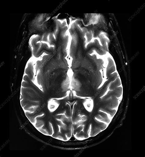 Wernicke's Encephalopathy on MRI - Stock Image - C043/0252 - Science Photo Library