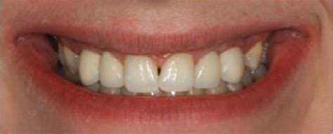 Maxillary Midline Diastema Closure After Replacement Of Primary Teeth