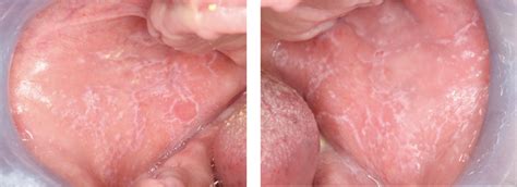 Reticular Oral Lichen Planus