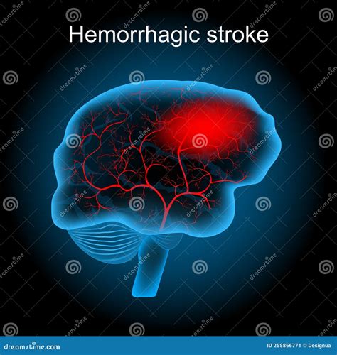 Hemorrhagic Stroke Human Brain With Blood Vessels And Hematoma Cartoon