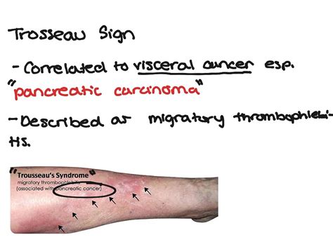 Trousseau Sign Science Showme