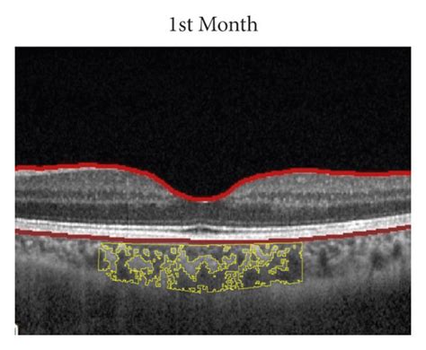 Choroidal Vascular Index Cvi The First Column Ac Shows The