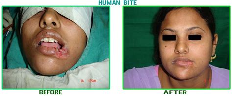 Dr V Bhattacharya Plastic Surgeon Plastic Surgery In Varanasi Best Plastic Surgeon