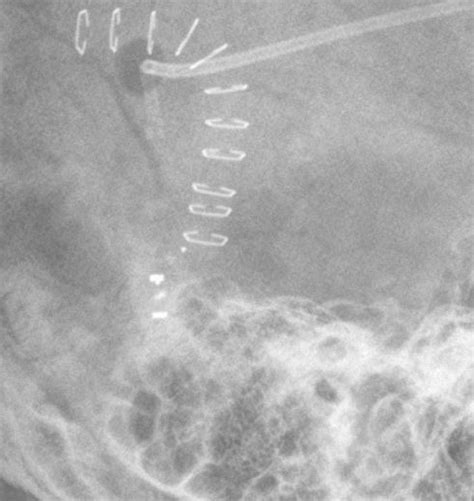 Codman Certas Programmable Shunt Image Radiopaedia Org