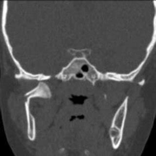 Coronal CT scan showing fracture of the right mandibular condyle with... | Download Scientific ...