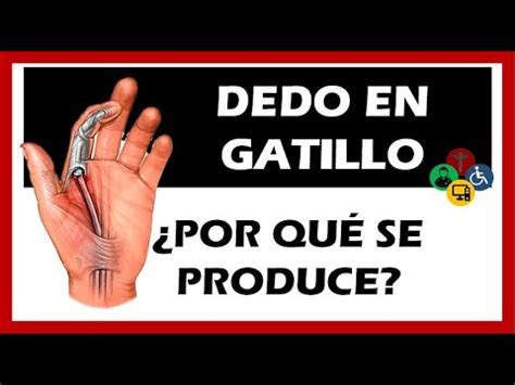 Dedo En Gatillo Sintomas Causas Y Tratamiento Youtube