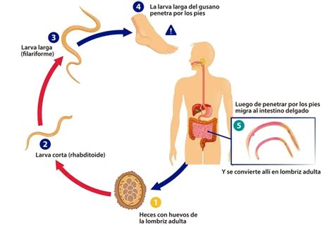 La Uncinariasis O Anquilostomiasis Escolar Abc Color