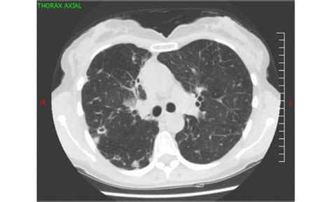 Ks Dilatations Des Bronches Comment évaluer La Sévérité De La Maladie