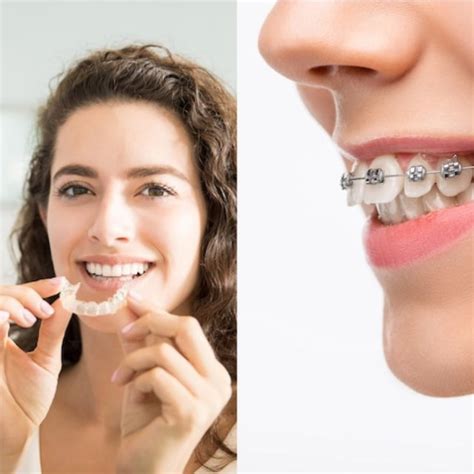 Invisalign Vs Braces Which Is Better Vip Dental Care