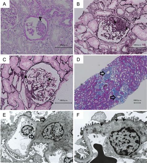 A Case Of Focal Segmental Glomerulosclerosis In An Adult Patient With