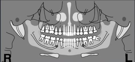 Panoramic Radiography Flashcards Quizlet