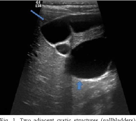 [pdf] Imaging Findings Of Gallbladder Duplication Case Report