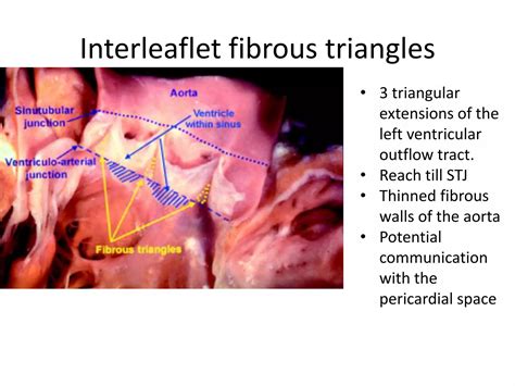 Aortic valve anatomy presentation | PPT