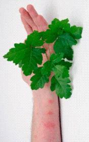 Poison Ivy – Symptoms, Causes and Home Remedies