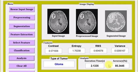 Types Of Brain Tumor Detection Using Image Processing Matlab Code