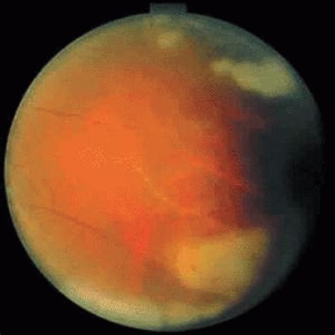 Acute Retinal Necrosis And Progressive Outer Retinal Necrosis Syndromes