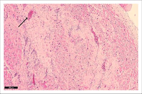 Well Formed Granulation Tissue With Collagen Deposition And Download Scientific Diagram