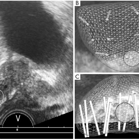 Complications of transrectal ultrasound (TRUS)-guided prostate biopsy ...