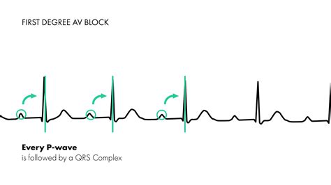 First Versus Second Degree Heart Block | Nucleotype