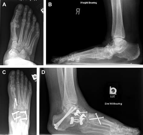 Triple Arthrodesis Foot And Ankle Clinics