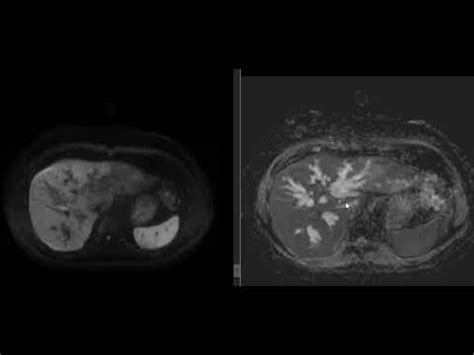 COLANGIOCARCINOMA TUMOR DE KLATSKIN COMO SE VE EN RESONANCIA