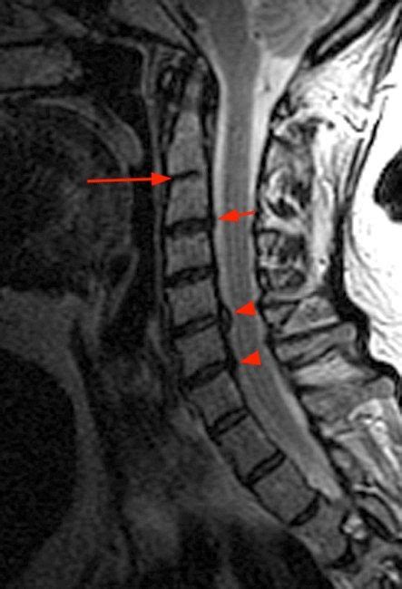 Klippel Feil Syndrome | Radsource