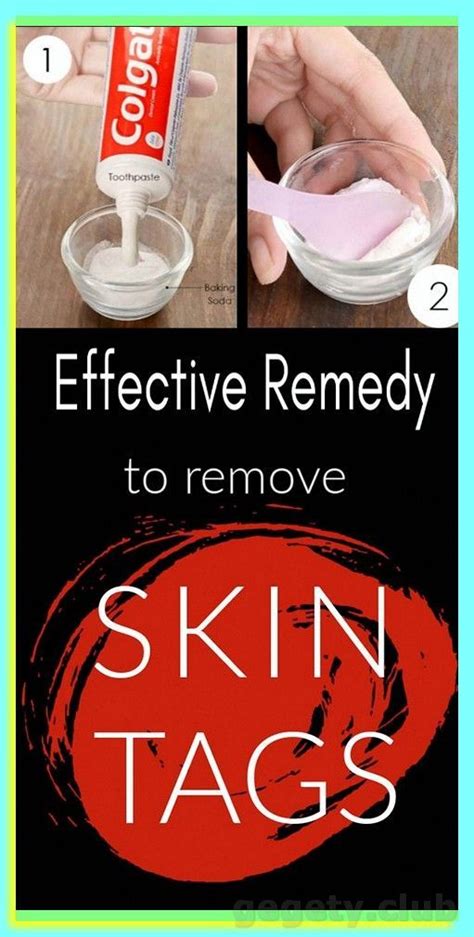 How To Remove Skin Tag In 1 Night Artofit