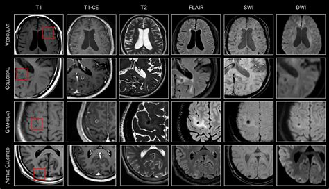 Neurocysticercosis Related Seizures Imaging Biomarkers Seizure European Journal Of Epilepsy