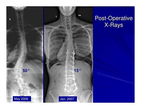 Case Review 5 43 Year Old Woman With Adult Idiopathic Scoliosis