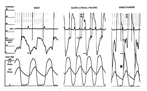 Changes In Phasic Coronary Blood Flow Velocity Profile In Relation To