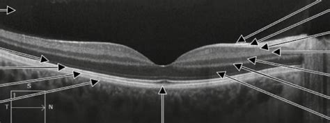 oct retina diagram quizlet