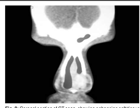 Figure 3 from Pediatric Lobular Capillary Hemangioma Nasal Cavity | Semantic Scholar