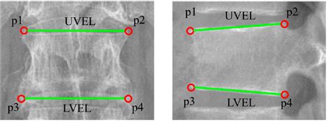 Figure 2 From Reliability Analysis Of Vertebral Landmark Labelling On Lumbar Spine X Ray Images