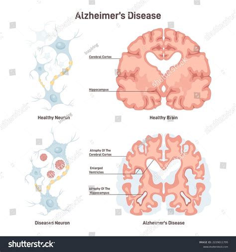 Alzheimers Disease Human Brain Cross Section Stock Vector Royalty Free