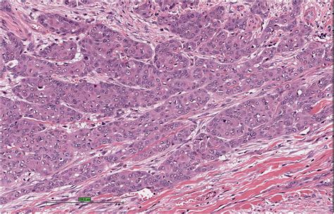 Clasificaci N De Carcinomas Peneanos