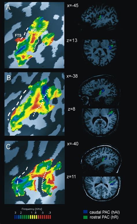 Mirror Symmetric Tonotopic Maps In Human Primary Auditory Cortex Neuron