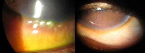 Ocular Surface Disease A Case Of Vernal Keratoconjunctivitis Contact Lens And Anterior Eye