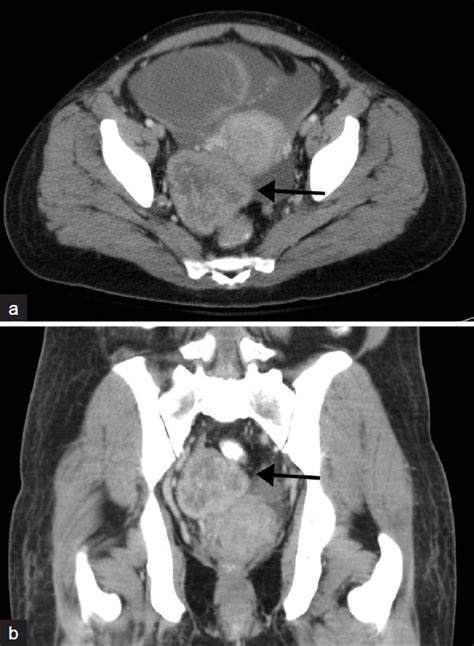 A Contrast Enhanced Axial And B Coronal Ct Images Through The