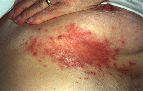 What Does Herpes Look Like In Female Body Infoupdate Org