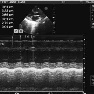 The D Echocardiogram Show Cardiomyopathy With Left Ventricular