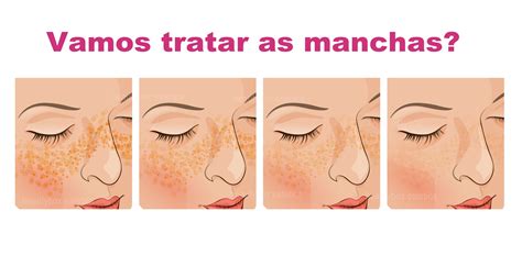 Laser Laser Curitiba Tratamento Para Controle De Melasma Est Tica