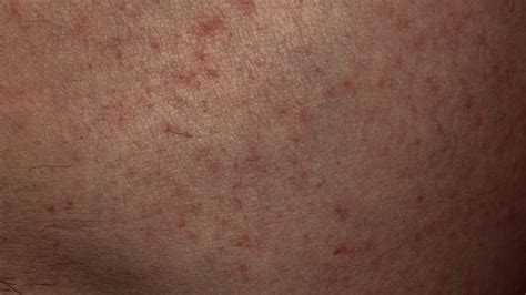 When To Worry About A Rash In Adults A Rash