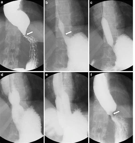 A Typical Fluoroscopically Guided Double Balloon Dilation For