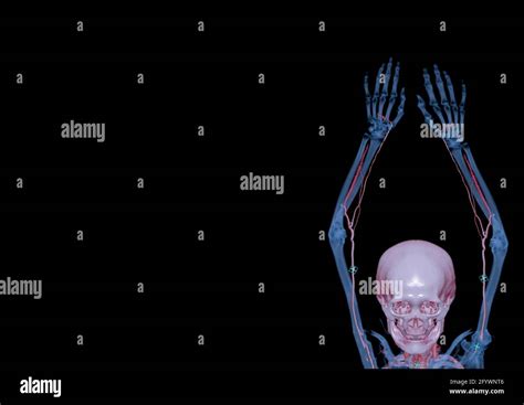 Cta Brachial Artery Or Ct Scan Of Upper Extremity Or The Arm 3d